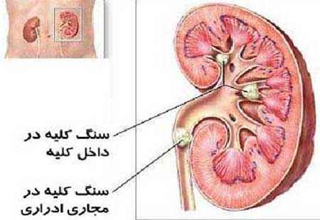 نقش تغذیه در پیشگیرى و درمان سنگ کلیه در سایت علی نوروزی